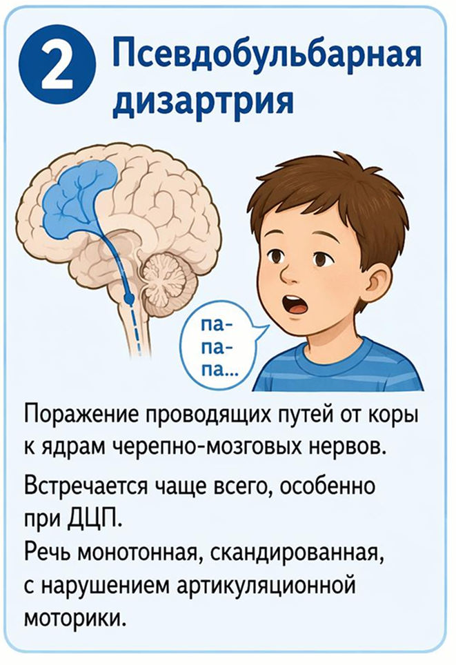 Псевдобульбарная дизартрия